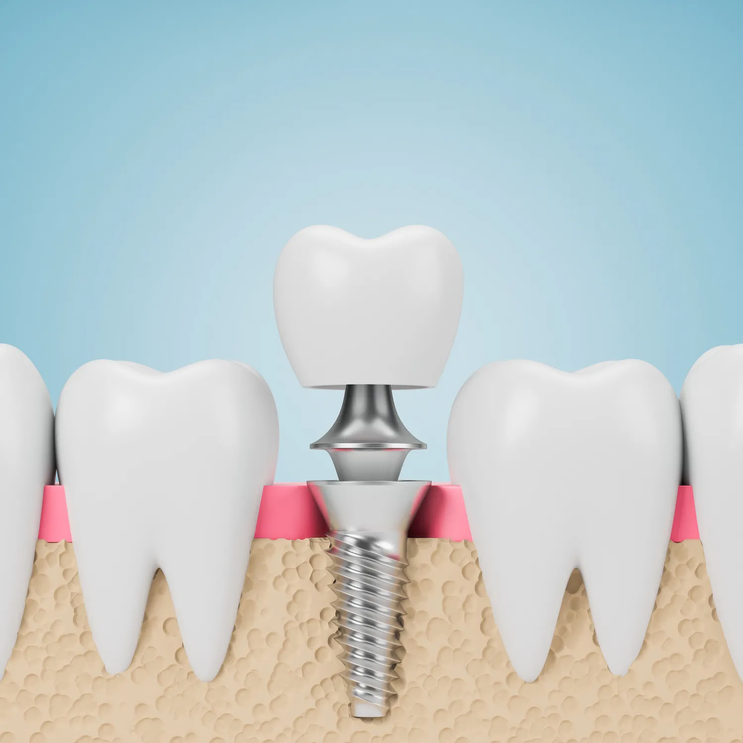 Dentysta Szczecin implanty