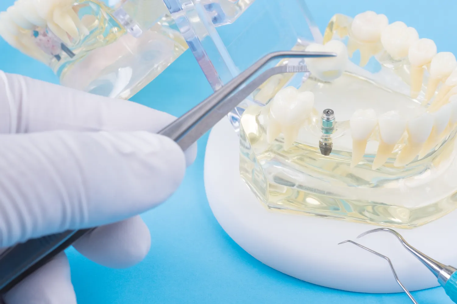 Leczenie kanałowe Poznań gdzie najlepiej